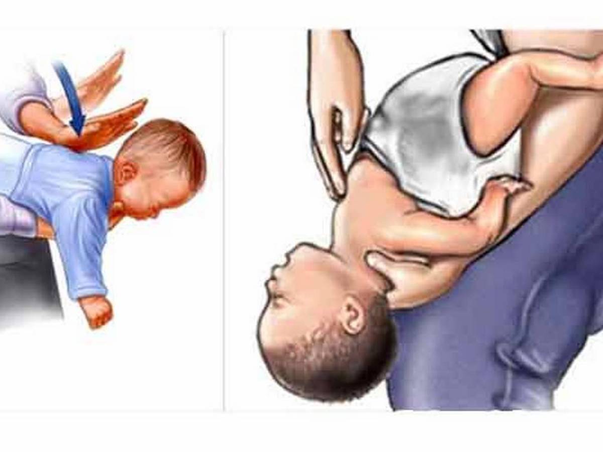 $!Tras las cinco palmadas interescapulares, debes mirar la boca del bebé para ver si se observa el objeto y, si es fácilmente accesible, cogerlo y sacarlo.