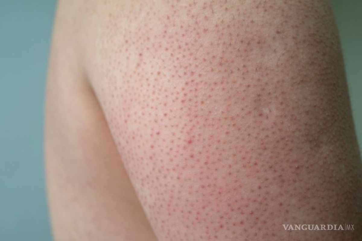 ¿Cómo eliminar la ‘piel de gallina’ de mis brazos y piernas?