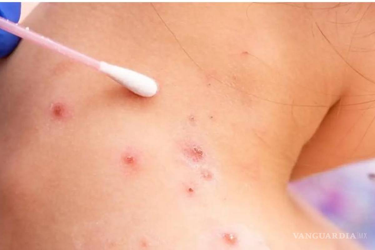 En estudio posible caso de viruela del mono en Saltillo; es un menor de 3 años que viajó a Cancún