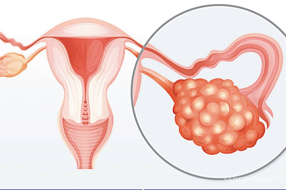 10 síntomas del tumor ovárico: Uno de los más difíciles de detectar