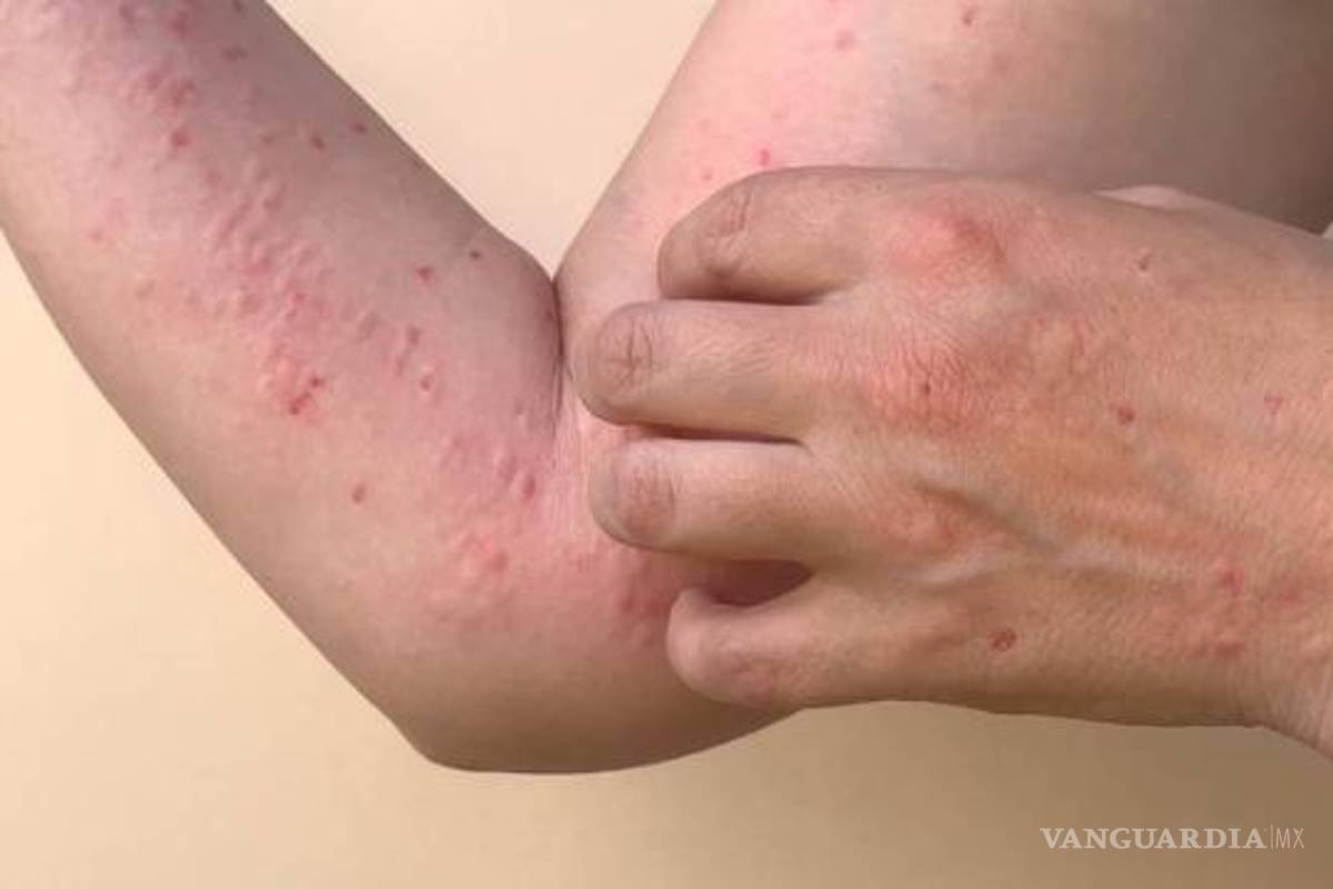 Confirman primer caso de viruela del mono en Morelos