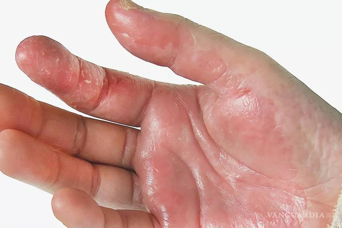 Alerta sanitaria... ¿Qué es el STSS? La ‘enfermedad carnívora’ mortal que azota a Japón