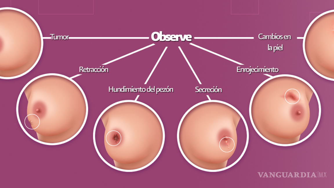 $!¿Cómo hacerse un autoexamen de exploración para detectar el cáncer de mama?