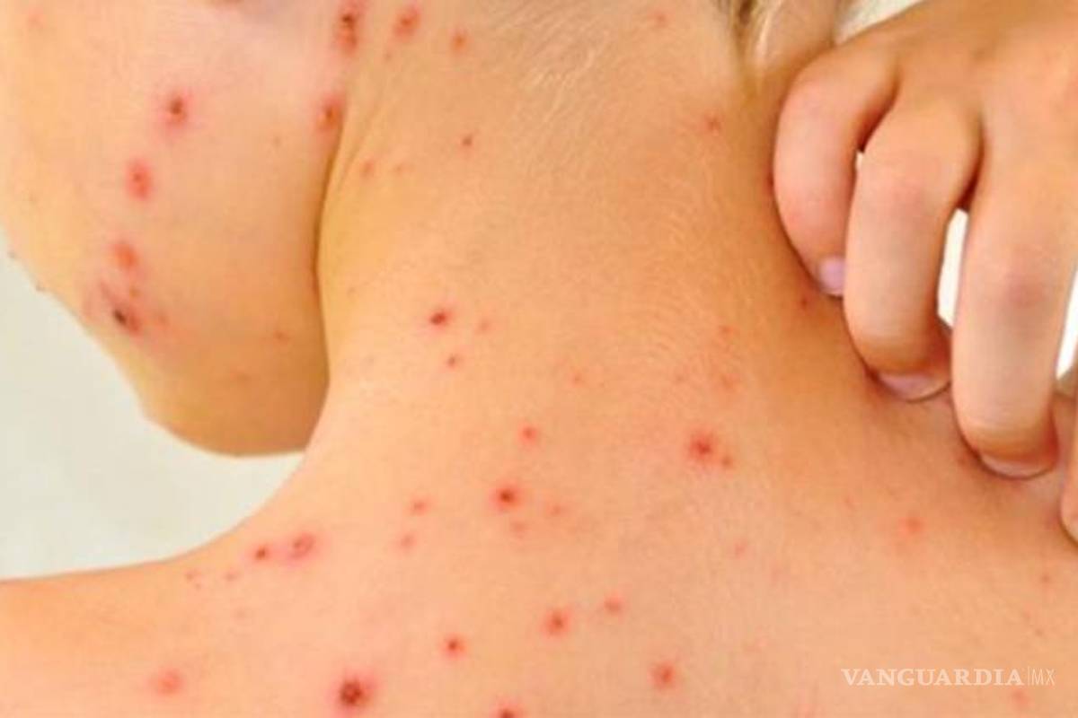 Salud Piedras Negras aplica más de tres mil dosis contra el sarampión y seguirá campaña