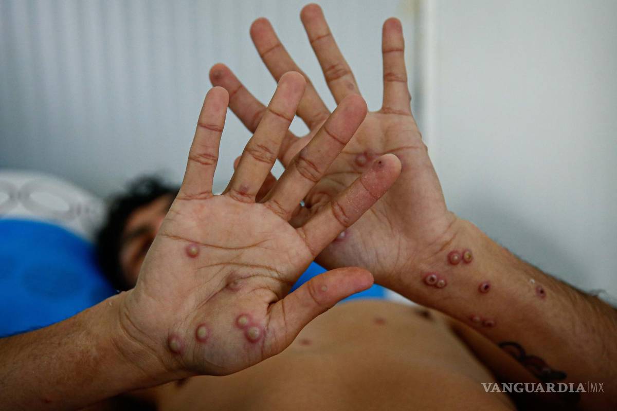 Coahuila: Analiza Secretaría de Salud posible caso de viruela del mono