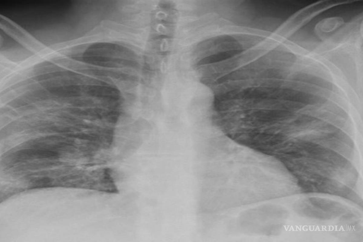 #NeumoníaAtípica: Usuarios aseguran que México está ocultando cifras de contagios de COVID-19