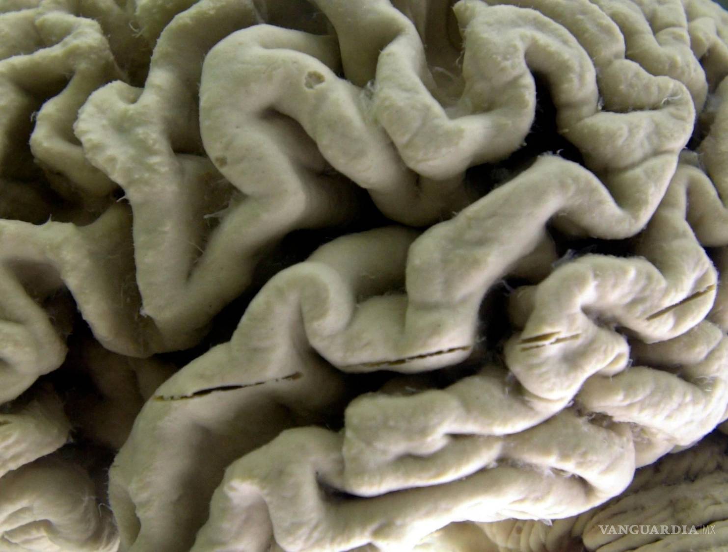 $!Un cerebro humano afectado por el Alzheimer en el Museo de Neuroanatomía de la Universidad de Buffalo, en Buffalo, Nueva York, el 7 de octubre de 2003.
