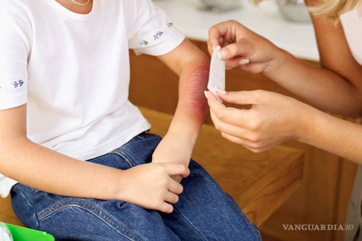 Remedios caseros para quemaduras podrían aumentar el daño