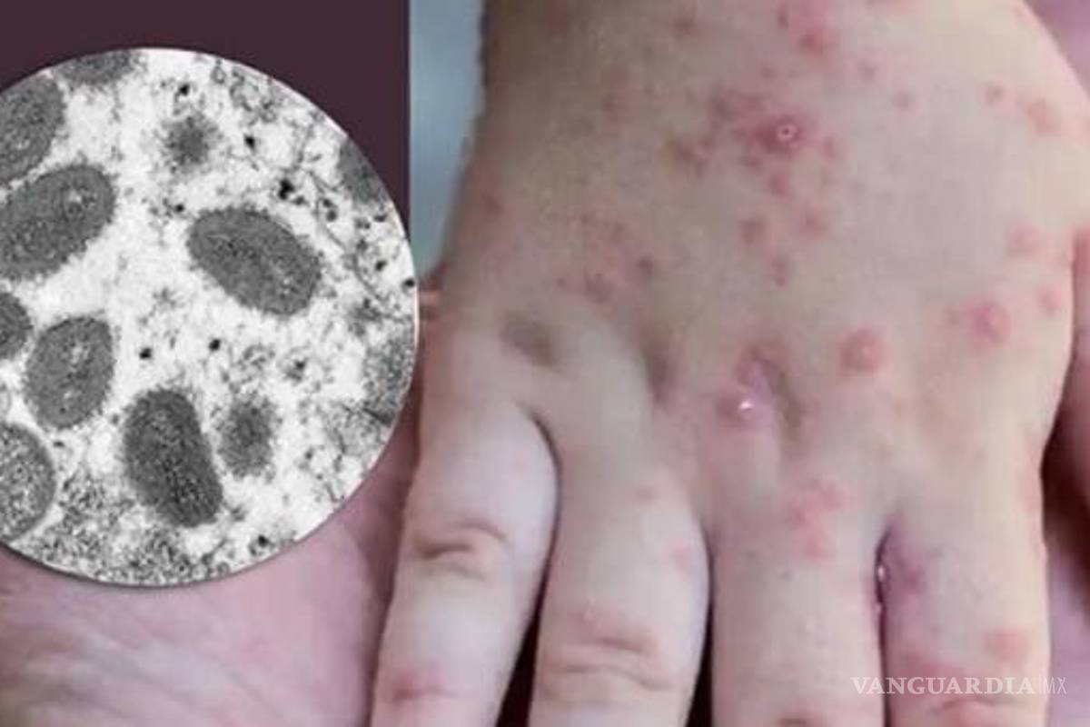 California e Illinois declaran emergencia por viruela del mono