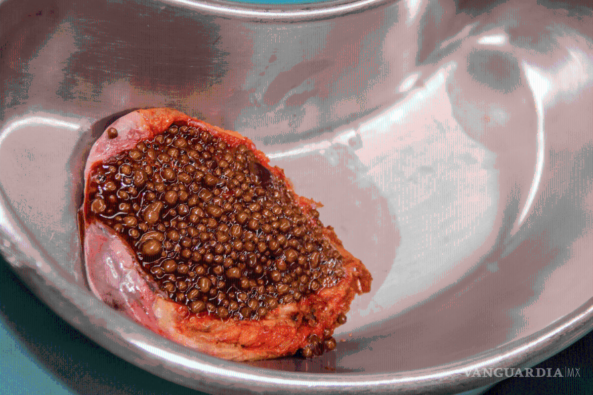 Joven de 16 años fallece cuando se le revienta la vesícula, en Saltillo