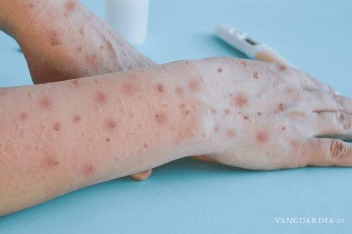 Registra Queretaro su segundo caso de viruela símica