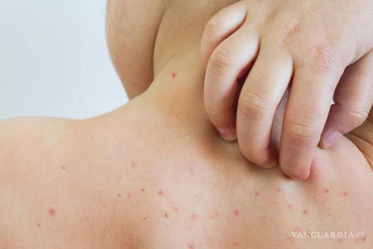 Incrementa el número de contagios de sarampión en Chihuahua