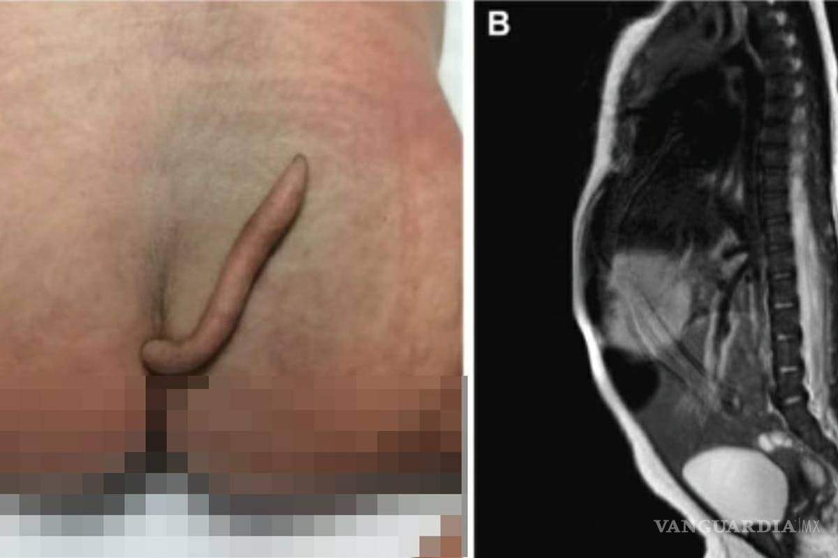 Nace en Nuevo León bebé con cola de 5.7 centímetros de largo, documenta revista médica