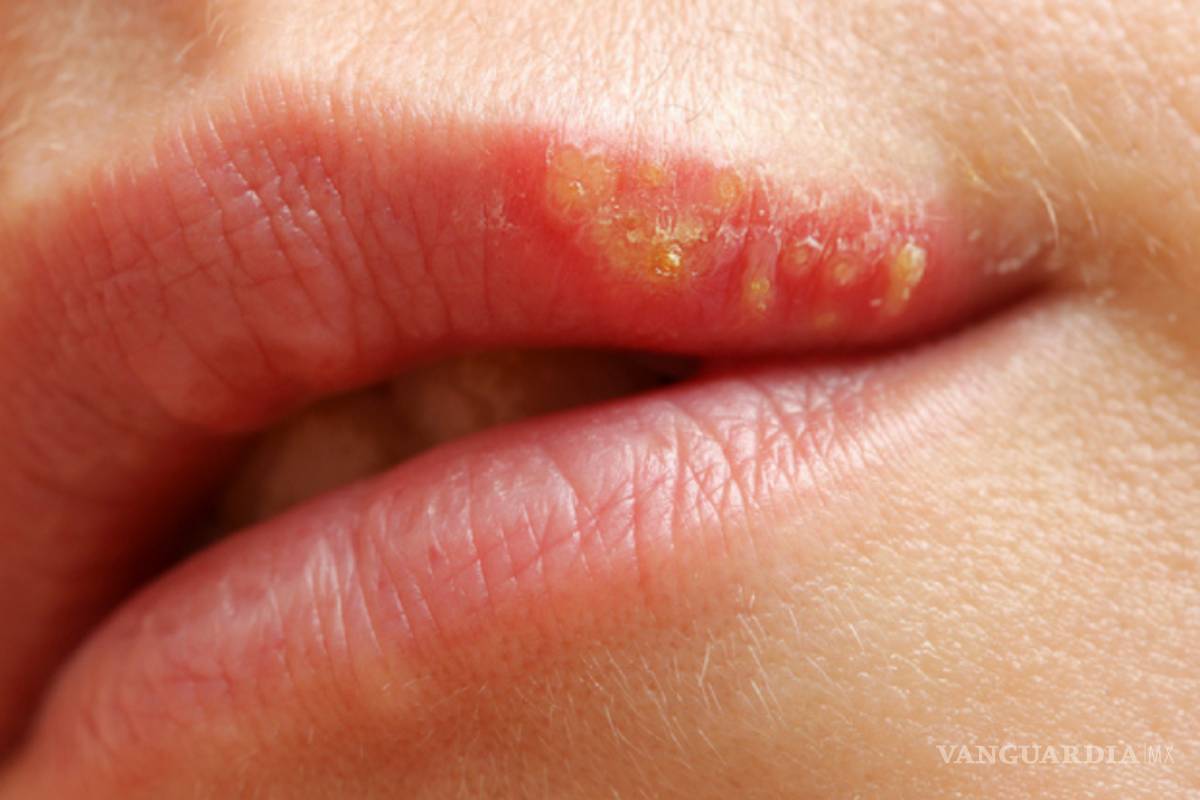 Herpes y Alzheimer están relacionados: estudio