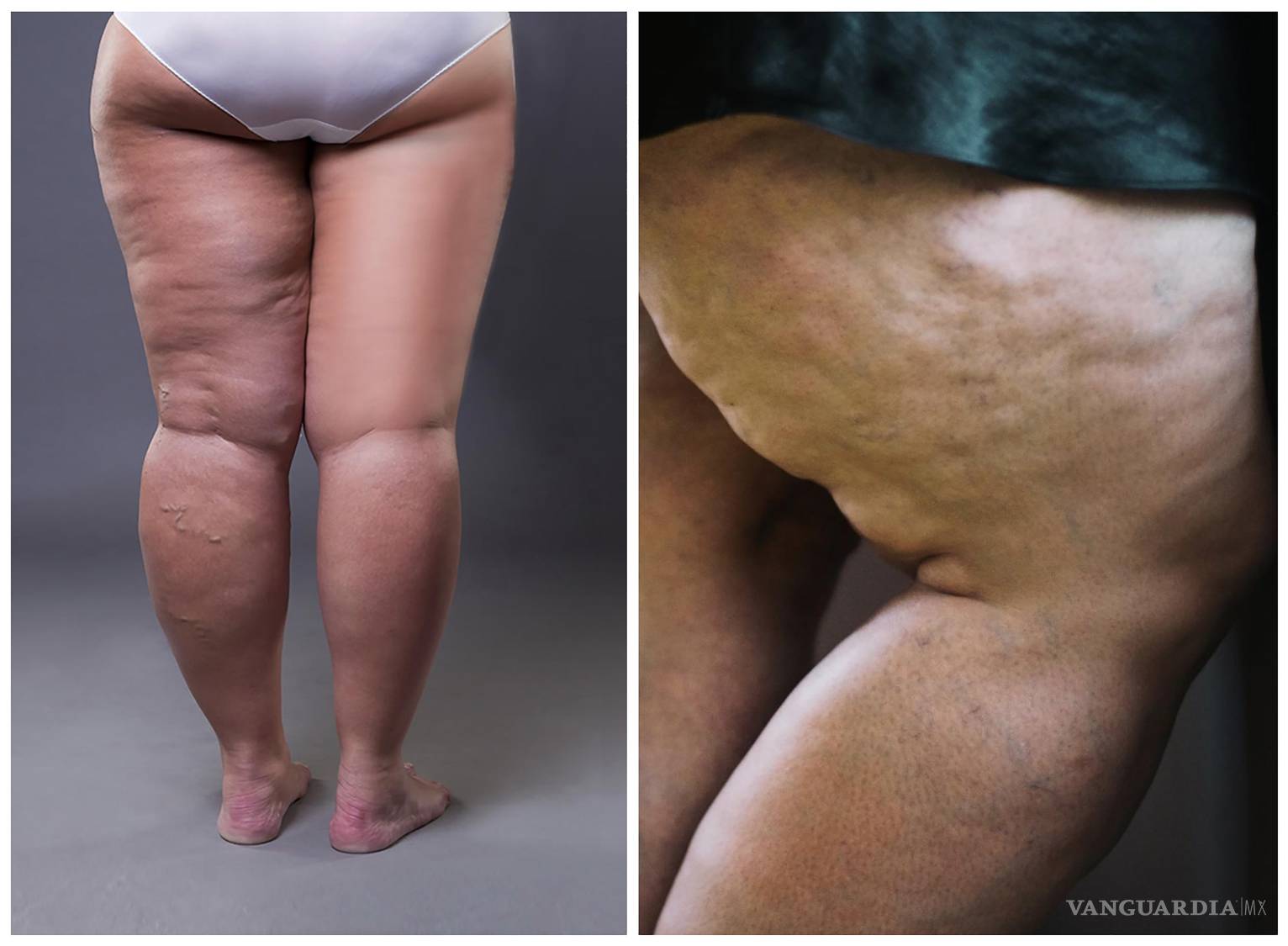 $!El lipedema afecta casi exclusivamente a las mujeres, afectando a un 10 por ciento de la población femenina.