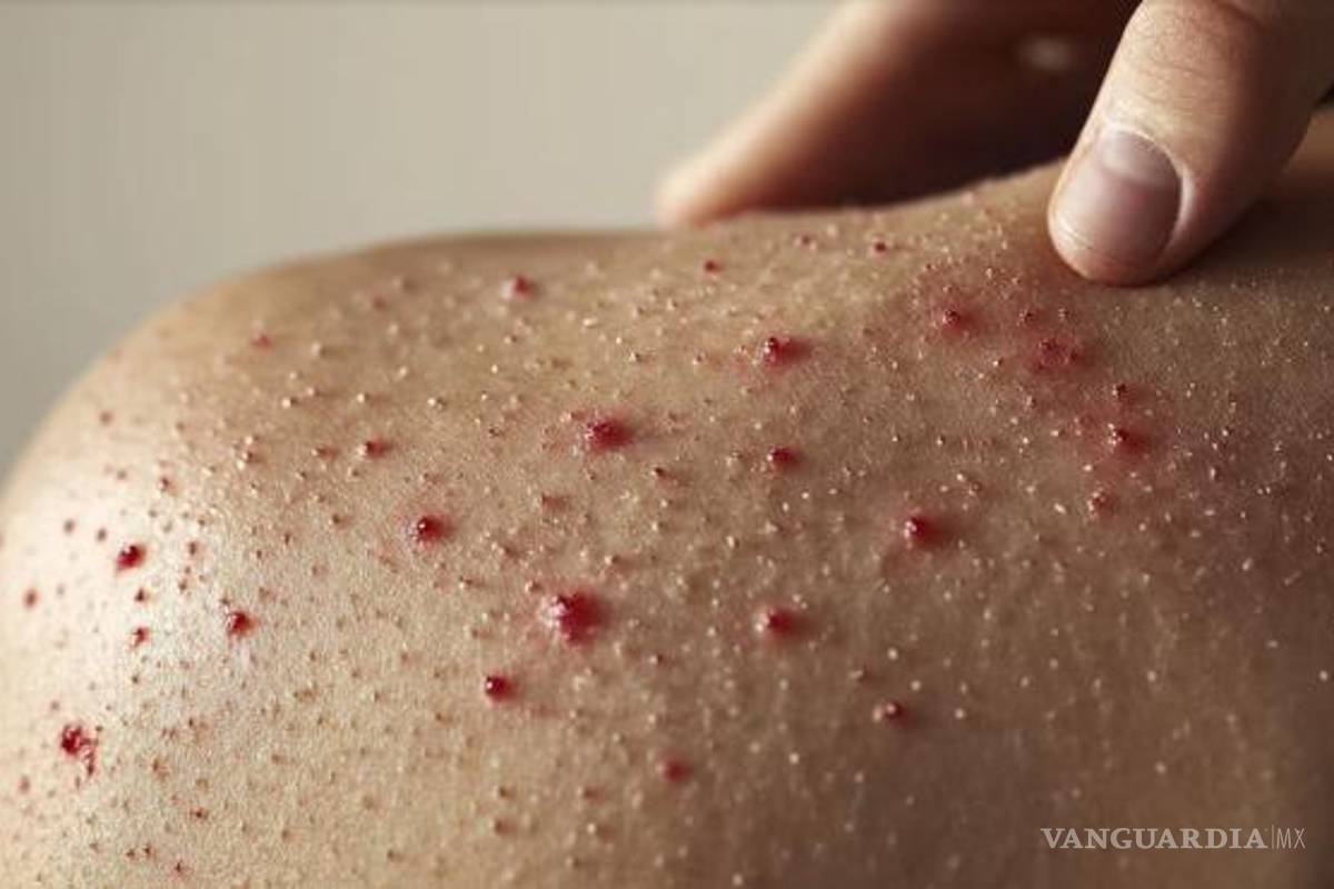 Suben a 18 los casos de sarampión en Coahuila; Saltillo lidera en contagios