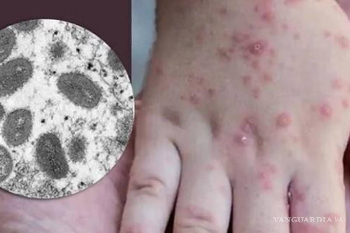 Cerco sanitario en Piedras Negras por posible caso de viruela del mono; tendrán confirmación la próxima semana