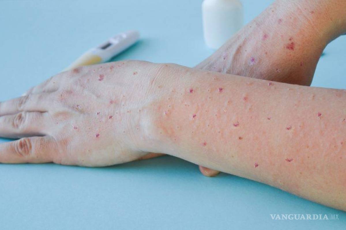 Muere en Texas un paciente por viruela del mono; es el primer deceso