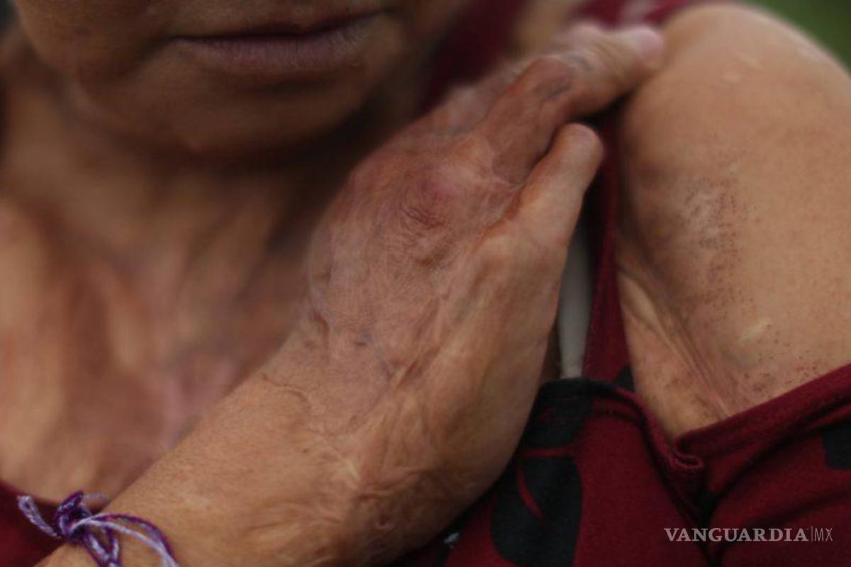 ¿Cuántas mujeres son víctimas de ataques con ácido en México?