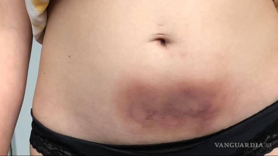 $!Denuncia que fue golpeada por su ex, hermano de candidata a diputada en Puebla