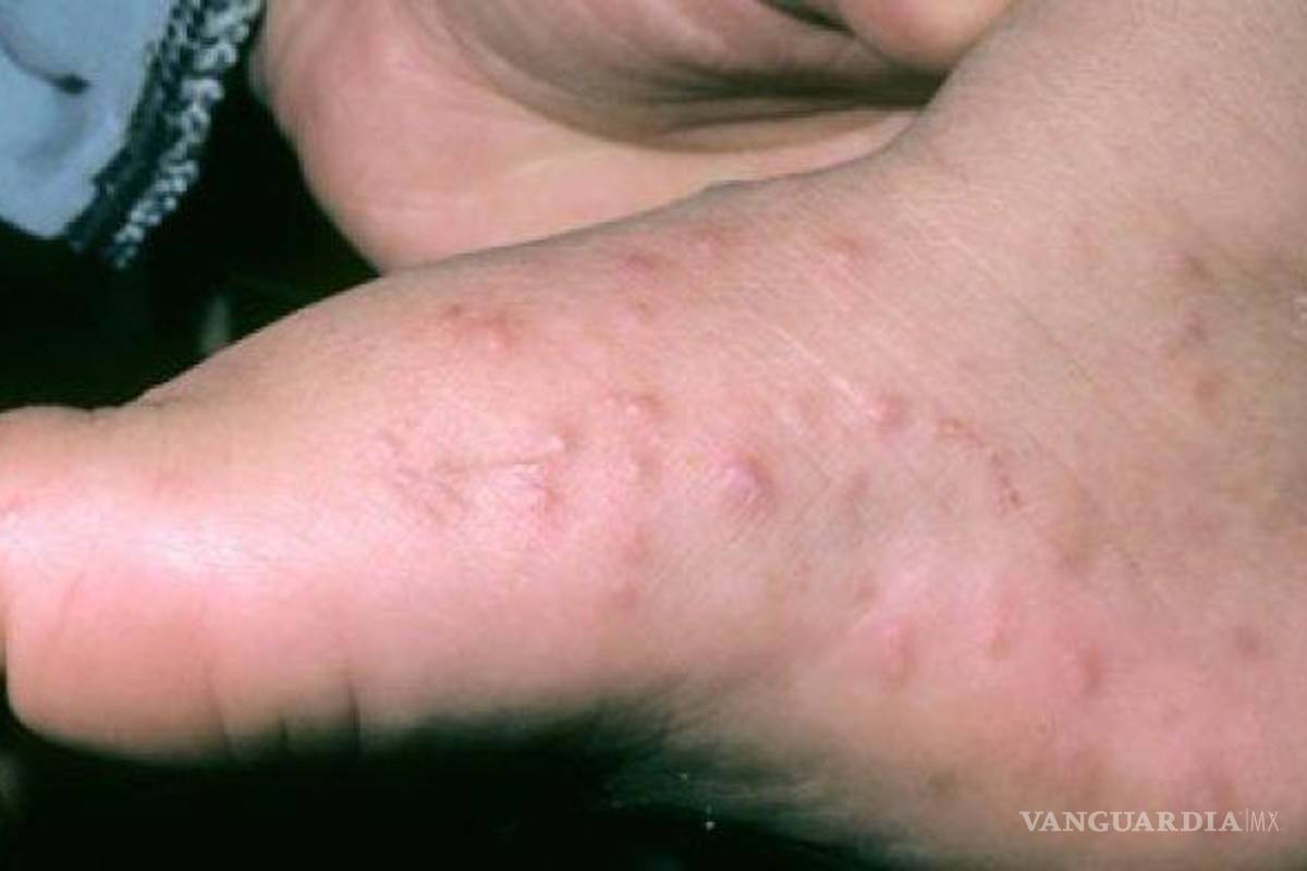 Coahuila: advierten sobre nuevo virus infantil; puede traer complicaciones cutáneas