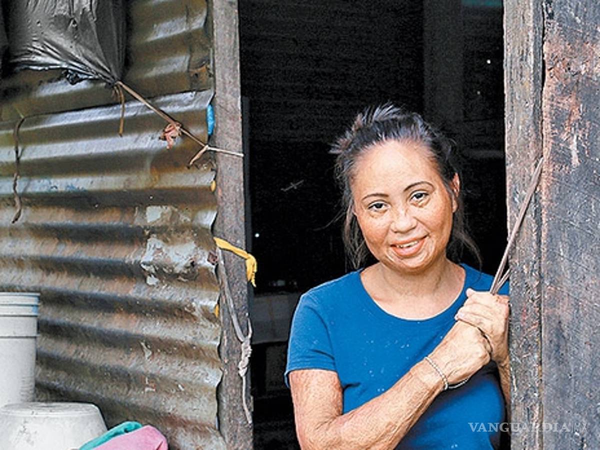 $!Quemados por el huachicol... los 19 mil heridos por el fuego en Puebla e Hidalgo