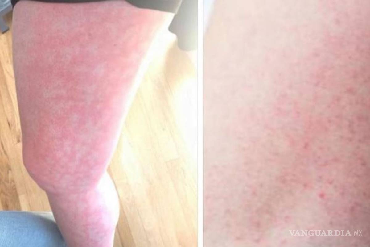 Científicos descubren nuevos síntomas que podrían ser indicios de COVID-19, sobre todo en los jóvenes