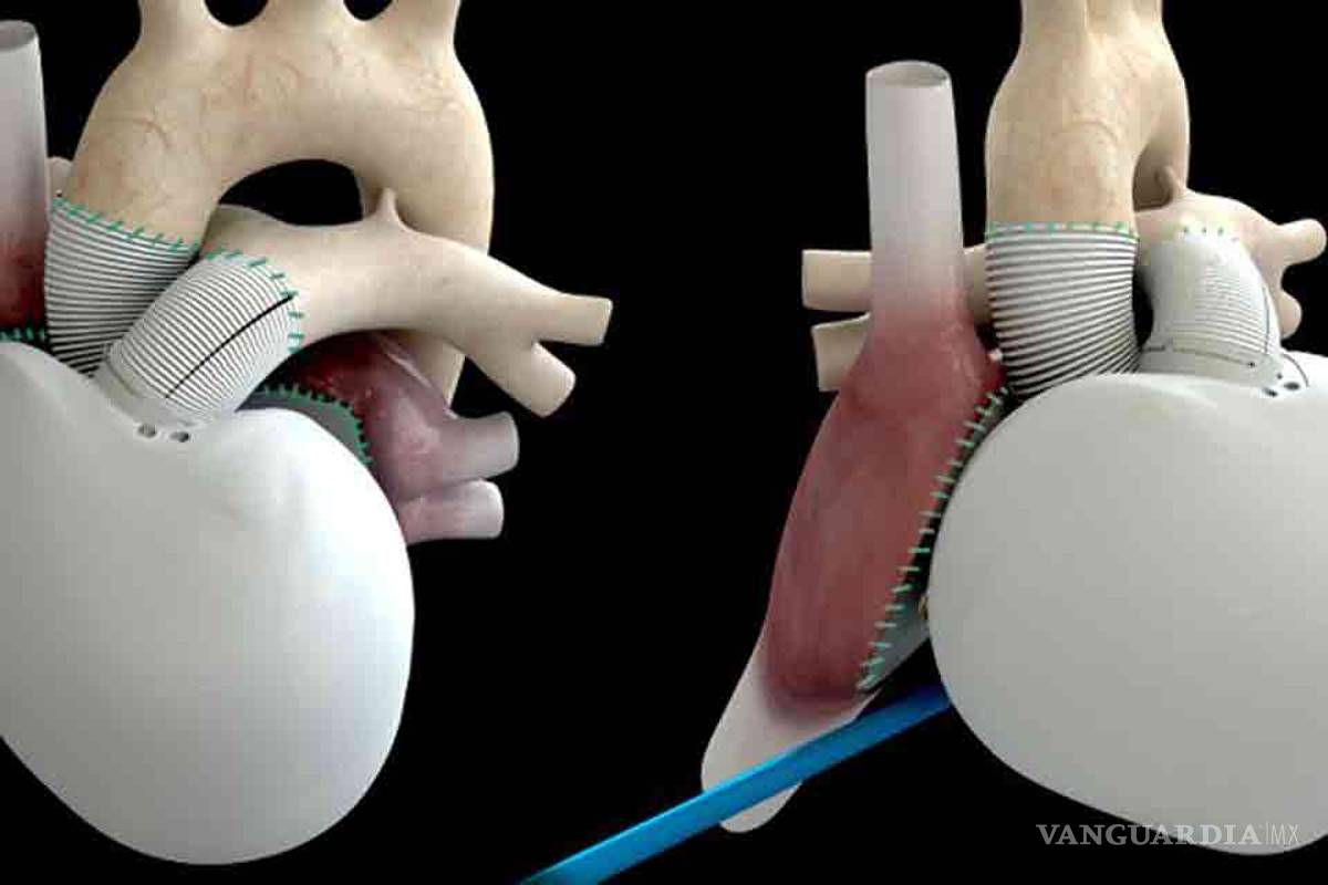 Muere paciente con corazón artificial en Francia