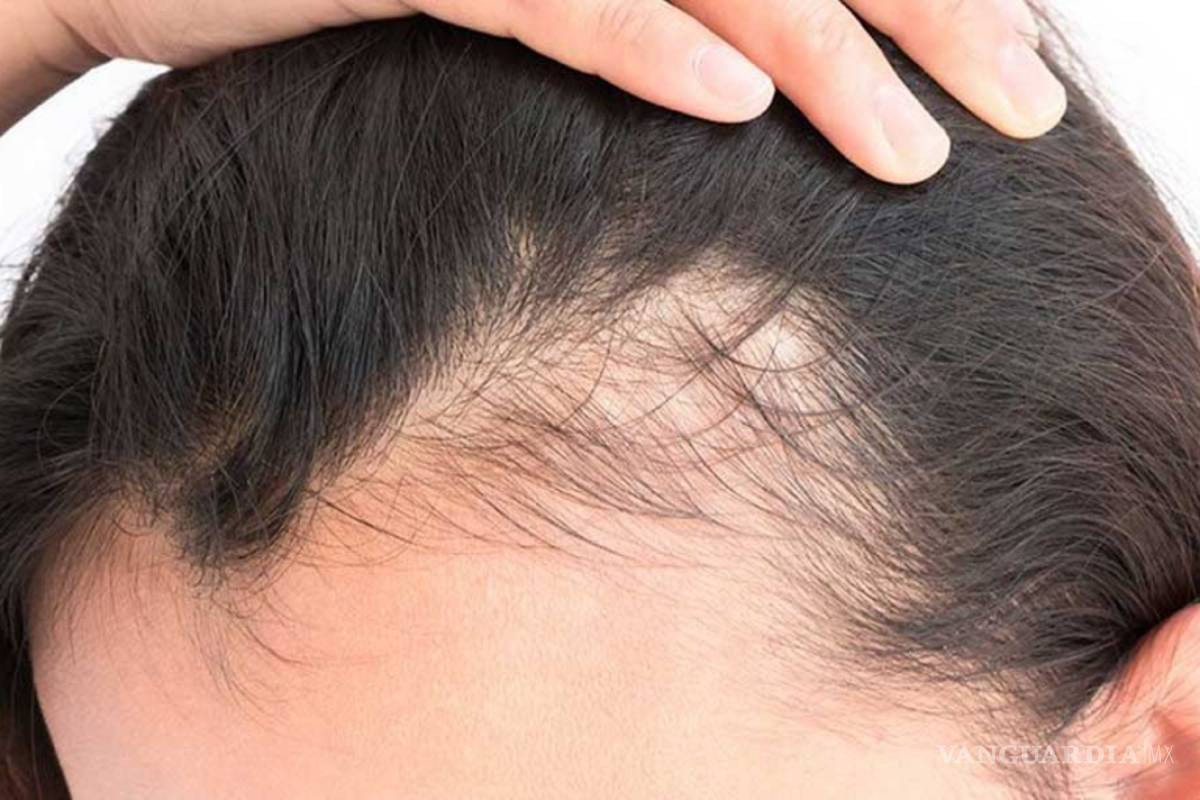 Sobrevivir el COVID-19 podría dejar sin cabello