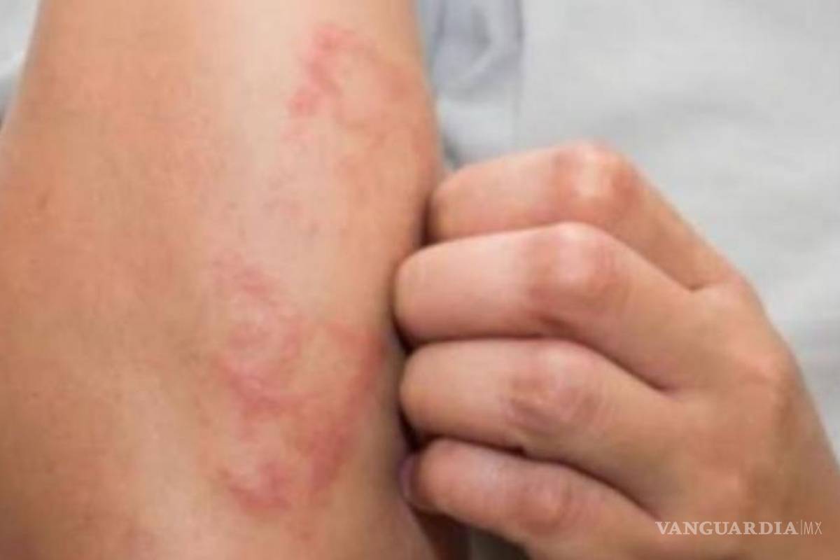 18 estados de la República Mexicana reportan casos de lepra; van 89 casos confirmados en 2020