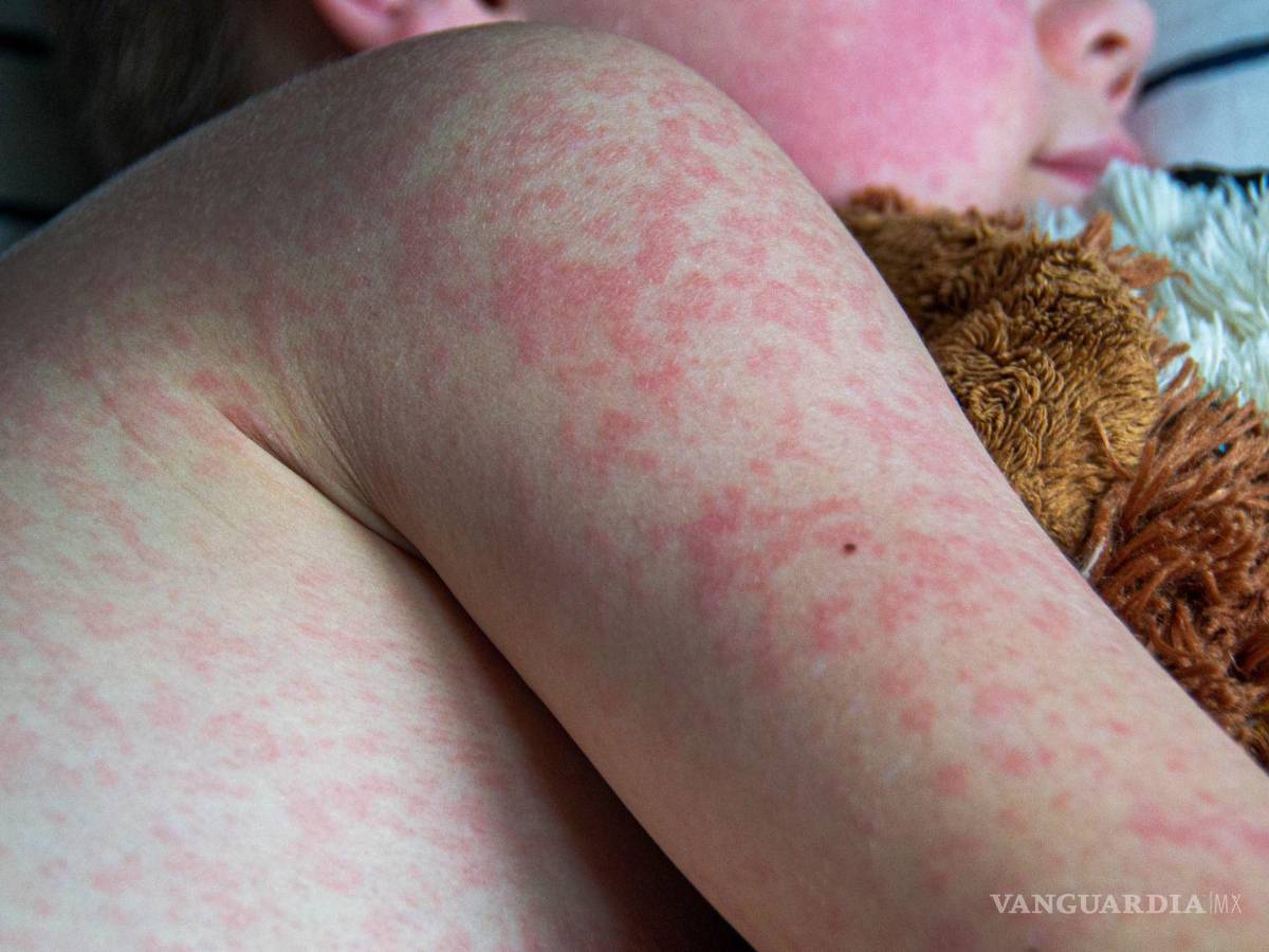 $!OPS revela que México, EU y Canadá son los más afectados en 2026 por sarampión; emite alerta