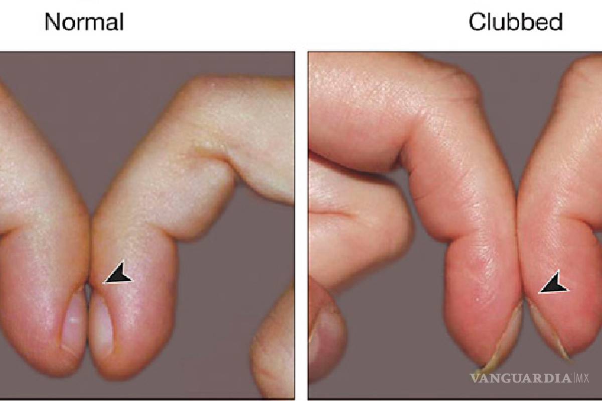 'Dedos hipocráticos': una forma en la que tus manos te avisan que algo anda mal