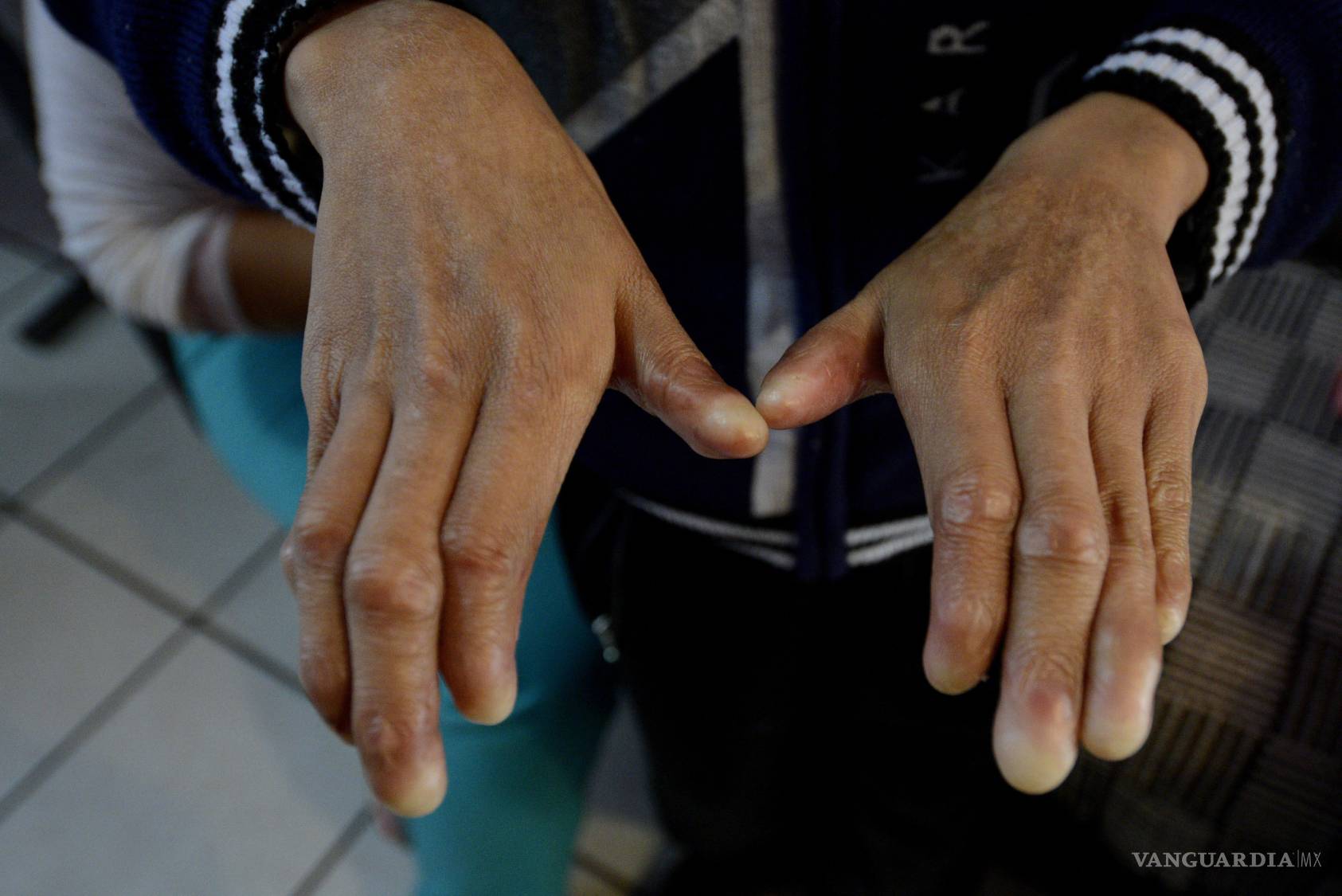 $!Espíritu de guerrero con piel de mariposa: Cuando el cuerpo es más frágil que el cristal