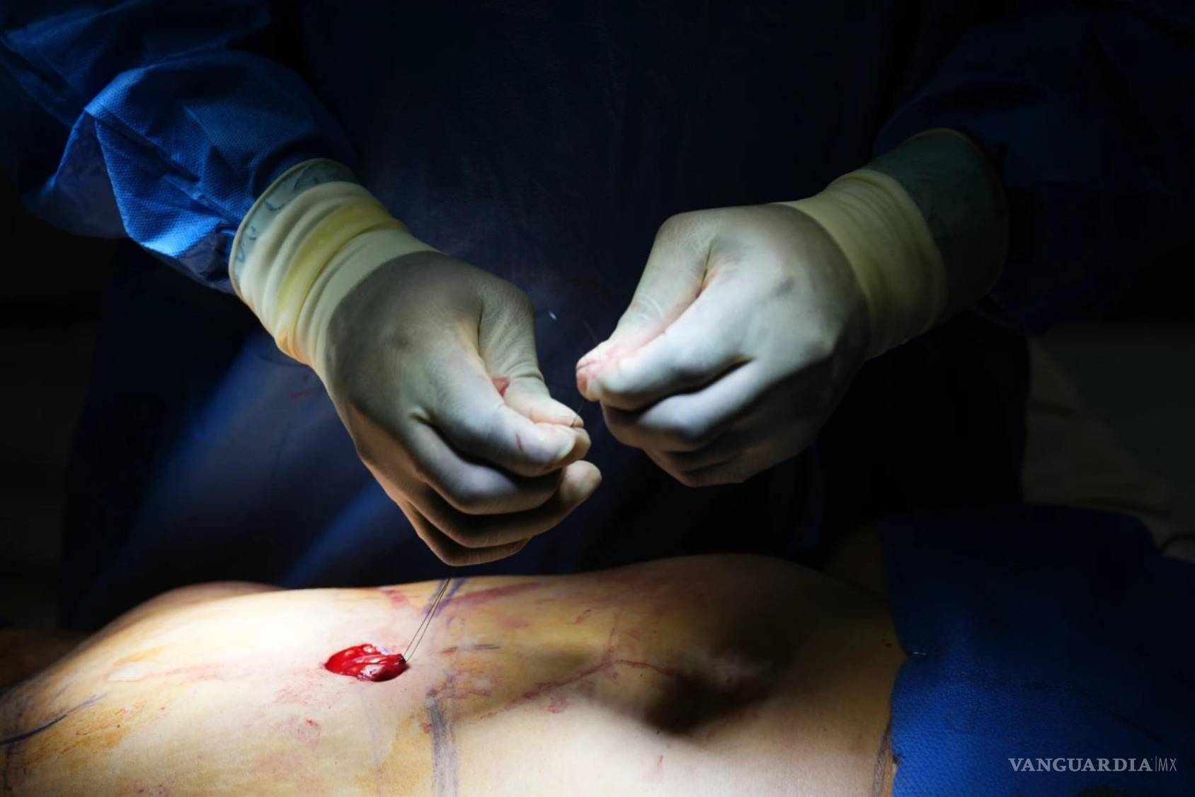 $!El cirujano plástico Dr. Michael Obeng realiza una cirugía de reconstrucción de la zona abdominal en un centro quirúrgico de Beverly Hills, California.