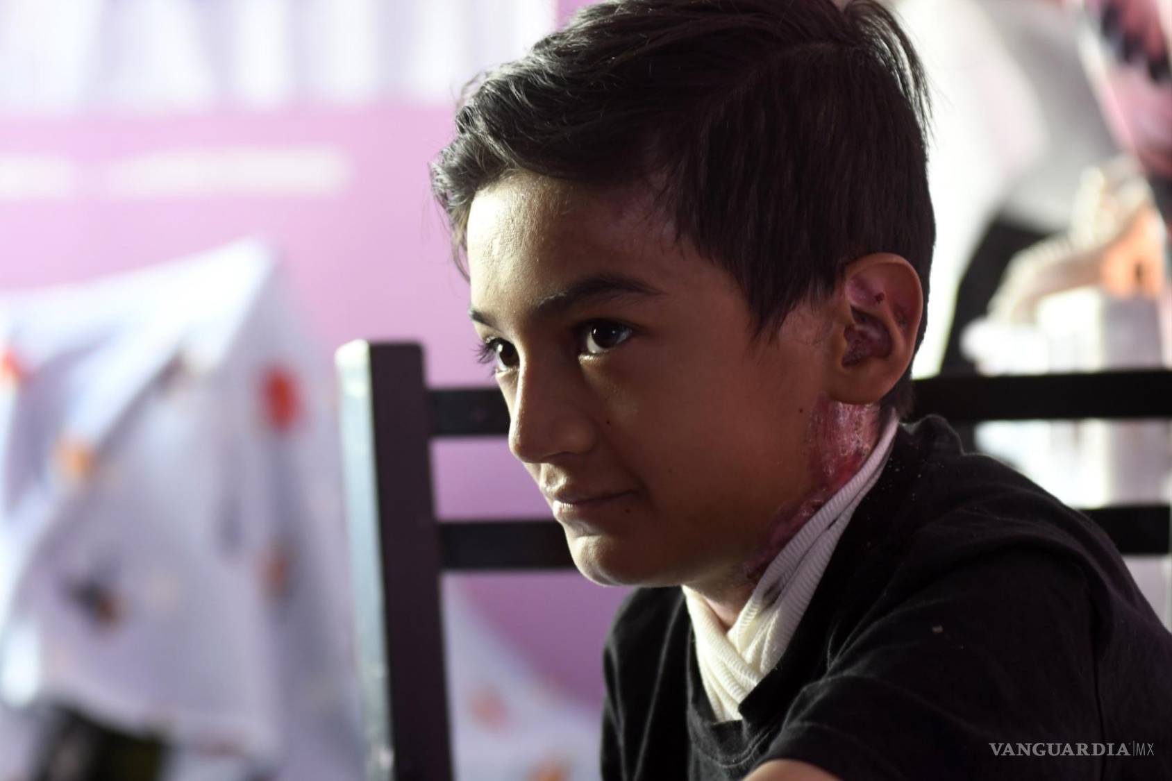 $!Edgar Alejandro Lozano, niño que padece la enfermedad de piel de mariposa