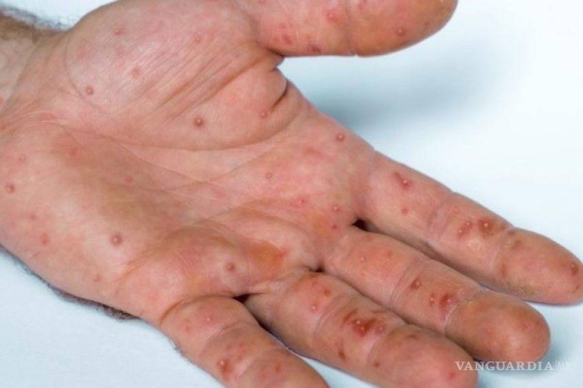 Más de 100 casos nuevos de viruela del mono en una semana en México, ya suman 504