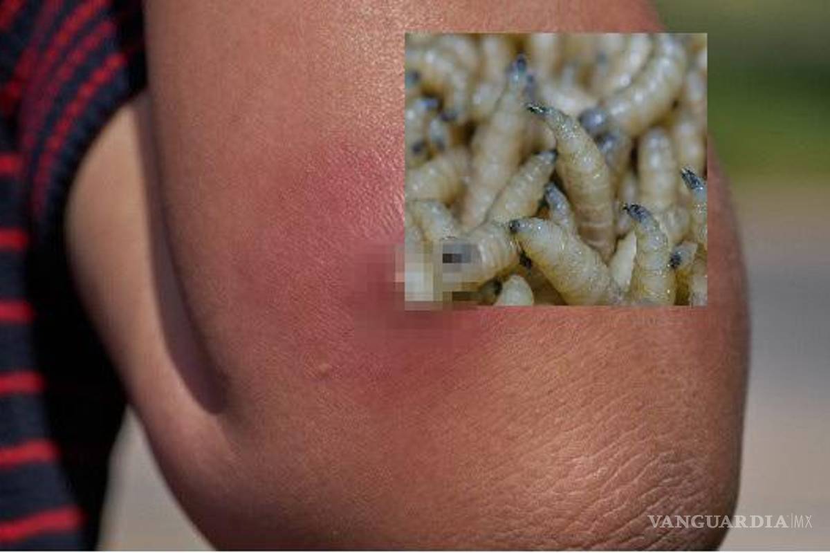Confirman dos casos de gusano barrenador en humanos en Oaxaca