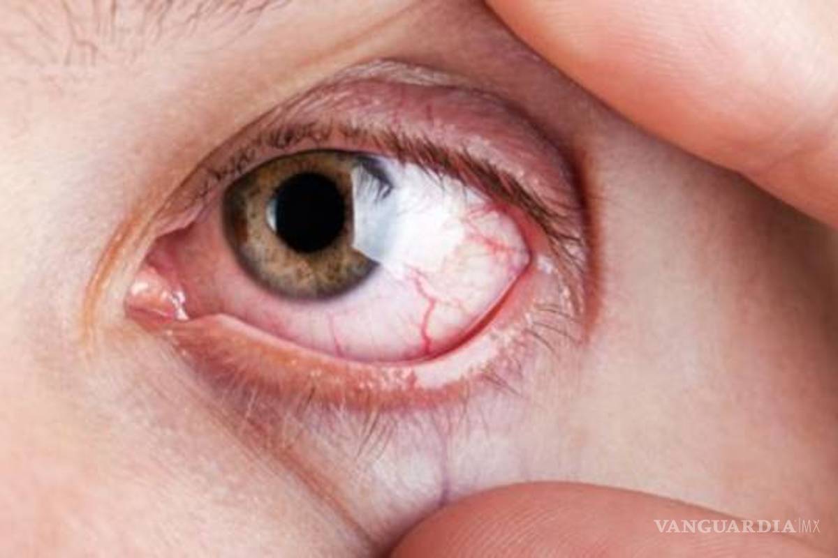 El 50% de personas que padecen glaucoma no lo saben