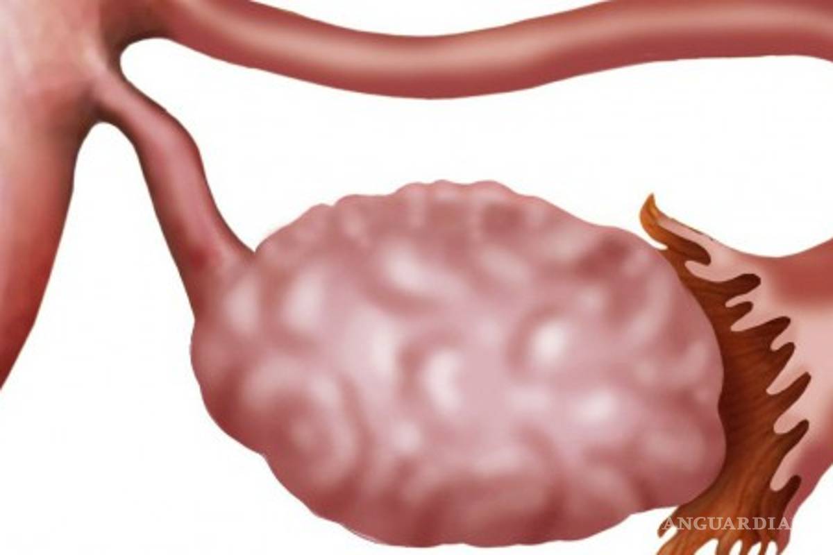 Más frecuente el cáncer de ovario en mujeres de 50 a 70 años: IMSS Coahuila