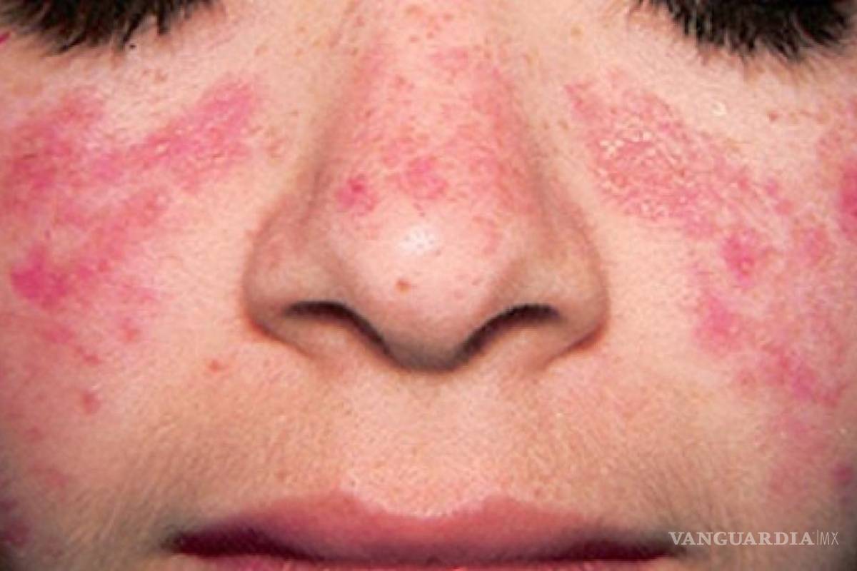 Buscan crear conciencia en el Día Internacional del Lupus