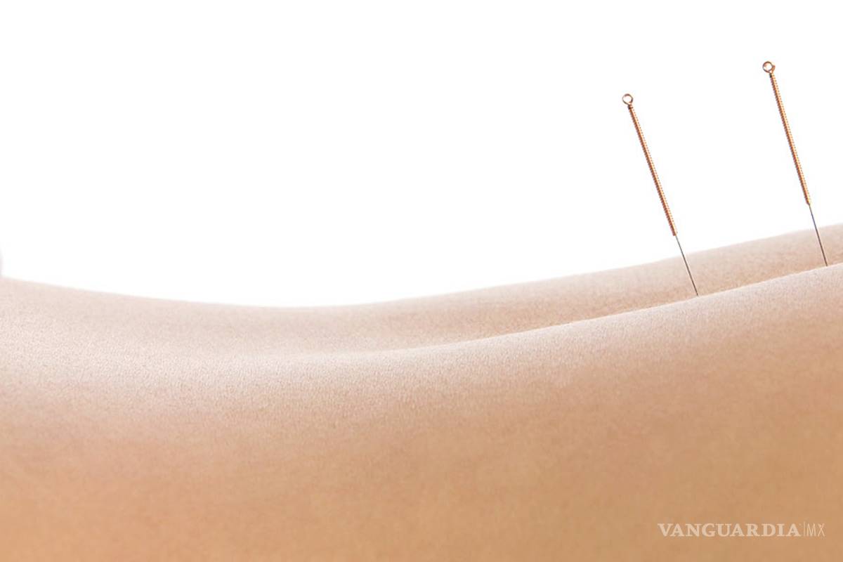 Todo lo que tienes que saber sobre la acupuntura (y sanar dolores)