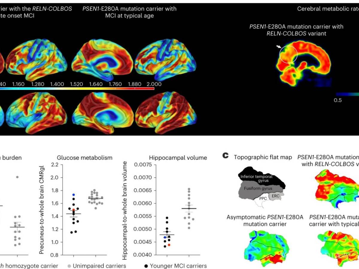 $!Grafica 1: Imagen del PET del portador del gen RELN-COLBOS (H3447R).