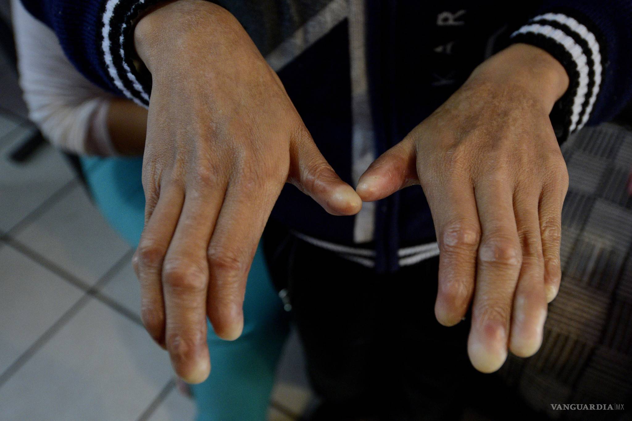 $!Espíritu de guerrero con piel de mariposa: Cuando el cuerpo es más frágil que el cristal