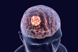 Descubren una nueva terapia para vencer el tumor cerebral