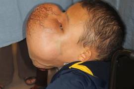 Muere niño al que le extirparon tumor de 4.5 kilos del rostro, días después de la operación