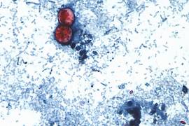 Salud Coahuila mantiene bajo vigilancia dos casos probables de ciclosporiasis detectados en Saltillo y Monclova.
