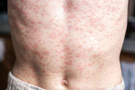 El brote de sarampión en México mantiene en alerta a las autoridades sanitarias.