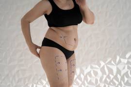 A menudo, las hinchazones producidas por el linfedema y el lipedema son confundidas la una con la otra y a su vez con la obesidad.
