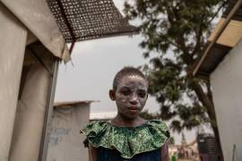 Lucie Habimana, de 13 años, tiene la cara cubierta con ungüento después de recibir tratamiento para el mpox en el Centro de Salud Munigi en Munigi, República Democrática del Congo.