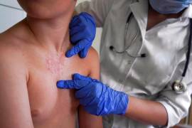 La Secretaría de Salud implementó cercos sanitarios en el entorno de los planteles y en los domicilios de los alumnos que enfermaron.